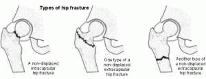 hip_fracture
